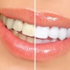 Como Clarear os Dentes