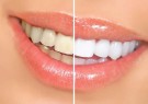 Como Clarear os Dentes