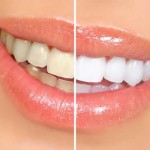 Como Clarear os Dentes