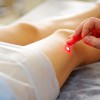 Acupuntura a Laser