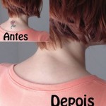 Remoção de Tatuagem